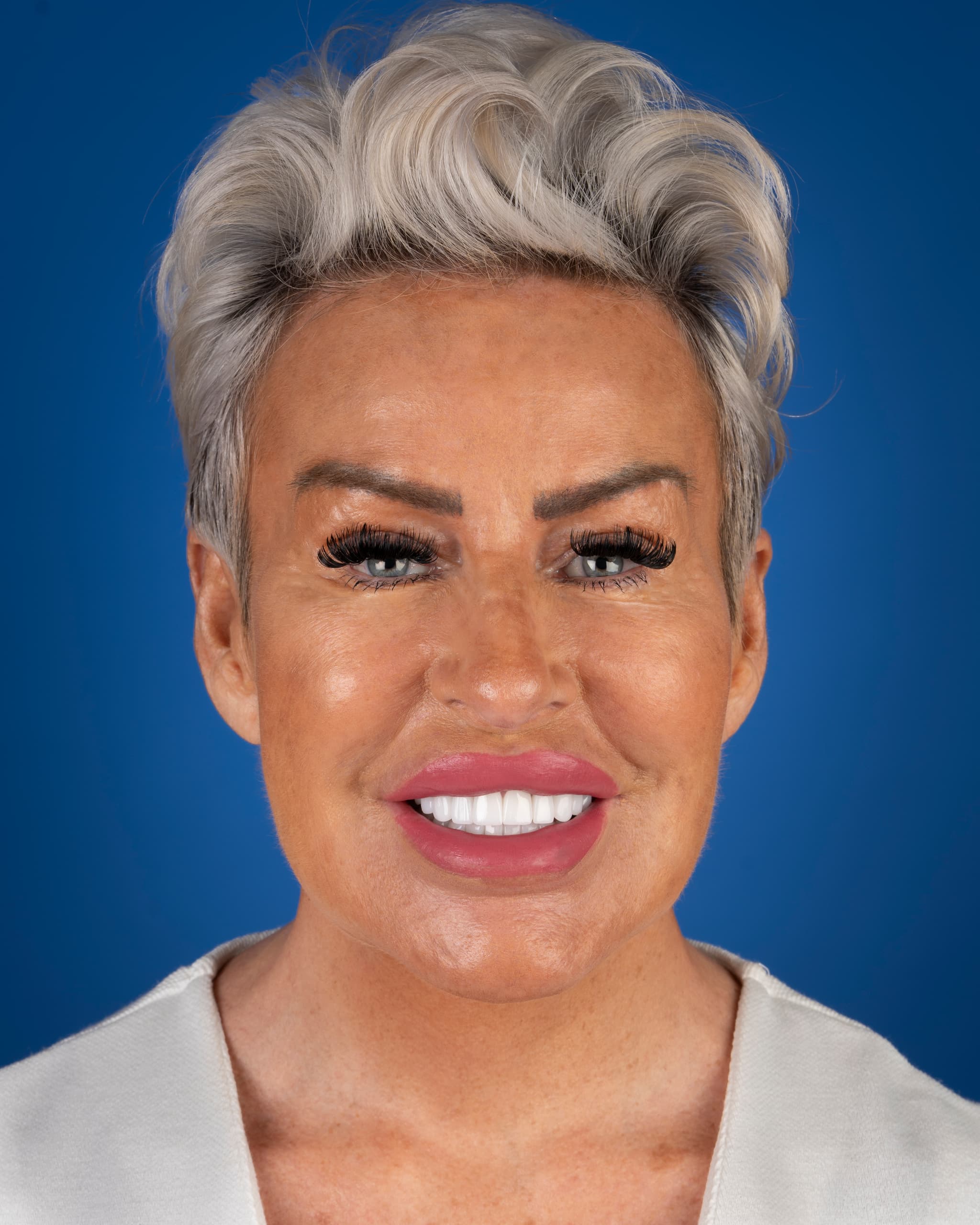 Polonya - Smile Design, 27x Zirconia Crowns