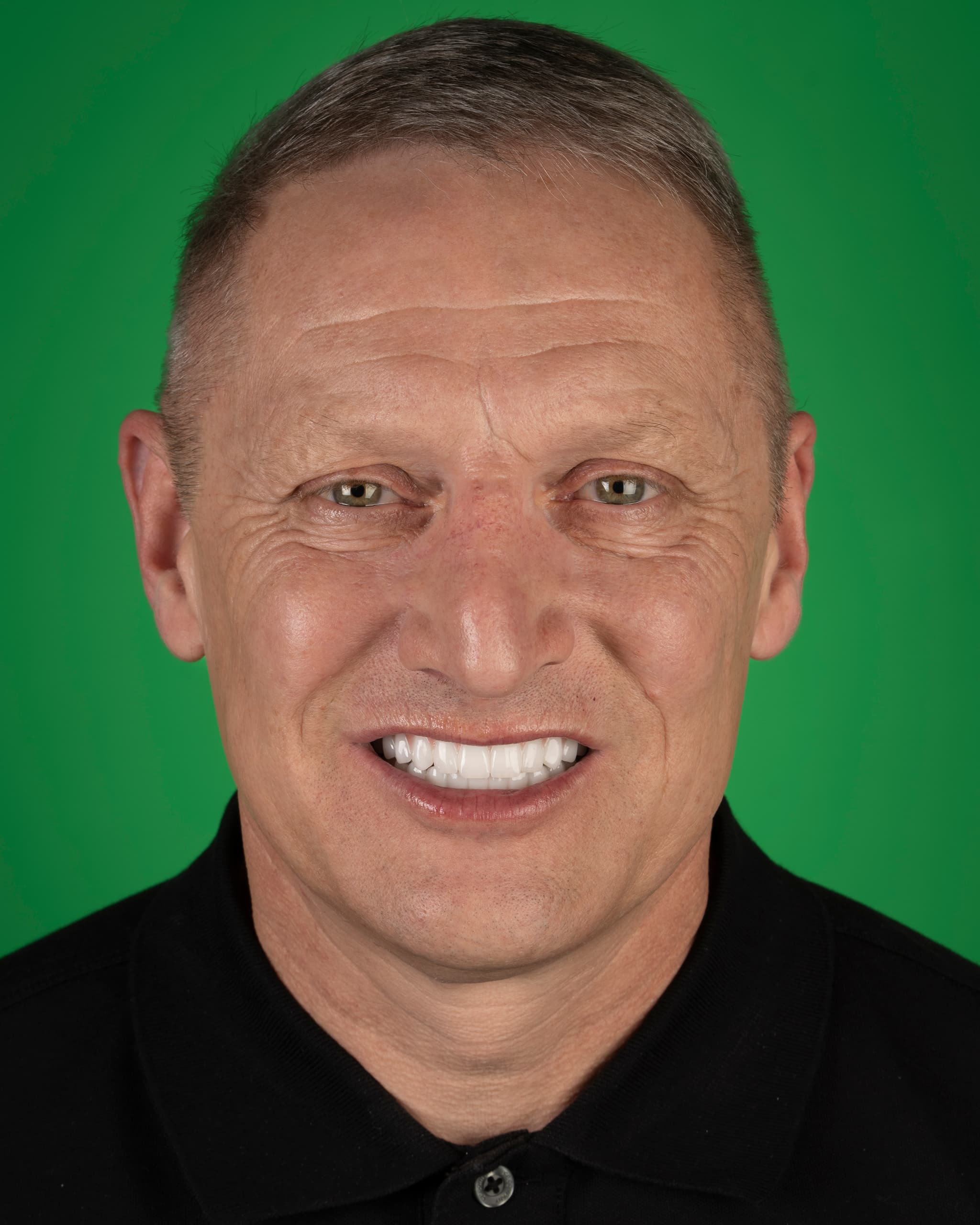 Birleşik Krallık - Smile Design, 24x Zirconia Crowns