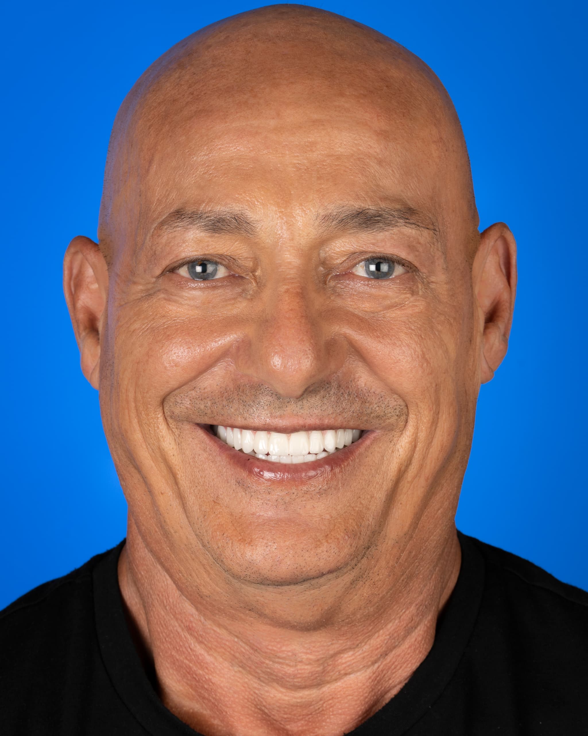 Malta - Smile Design, 28x Zirconia Crowns