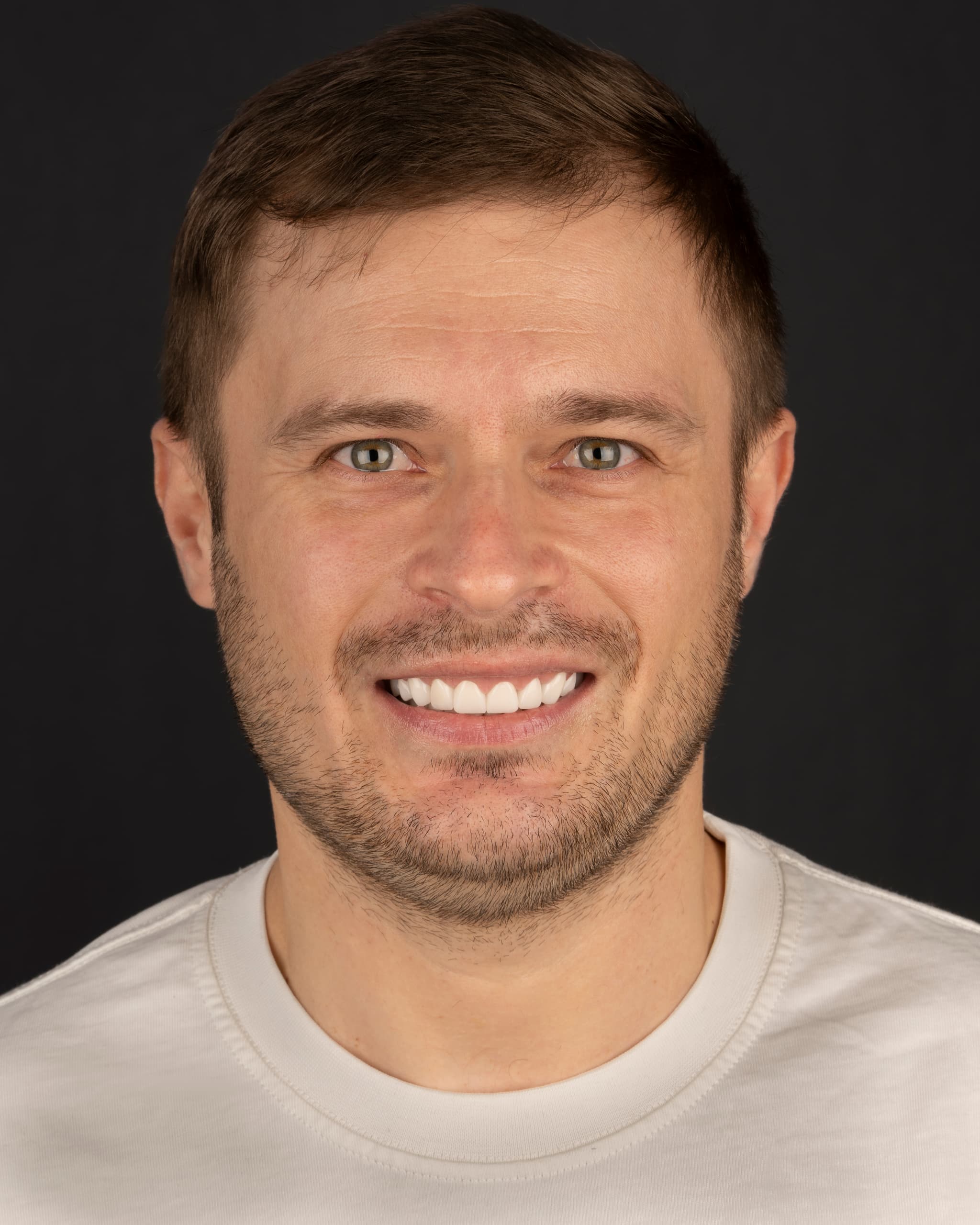 Poland - Smile Design, 28x Zirconia Crowns