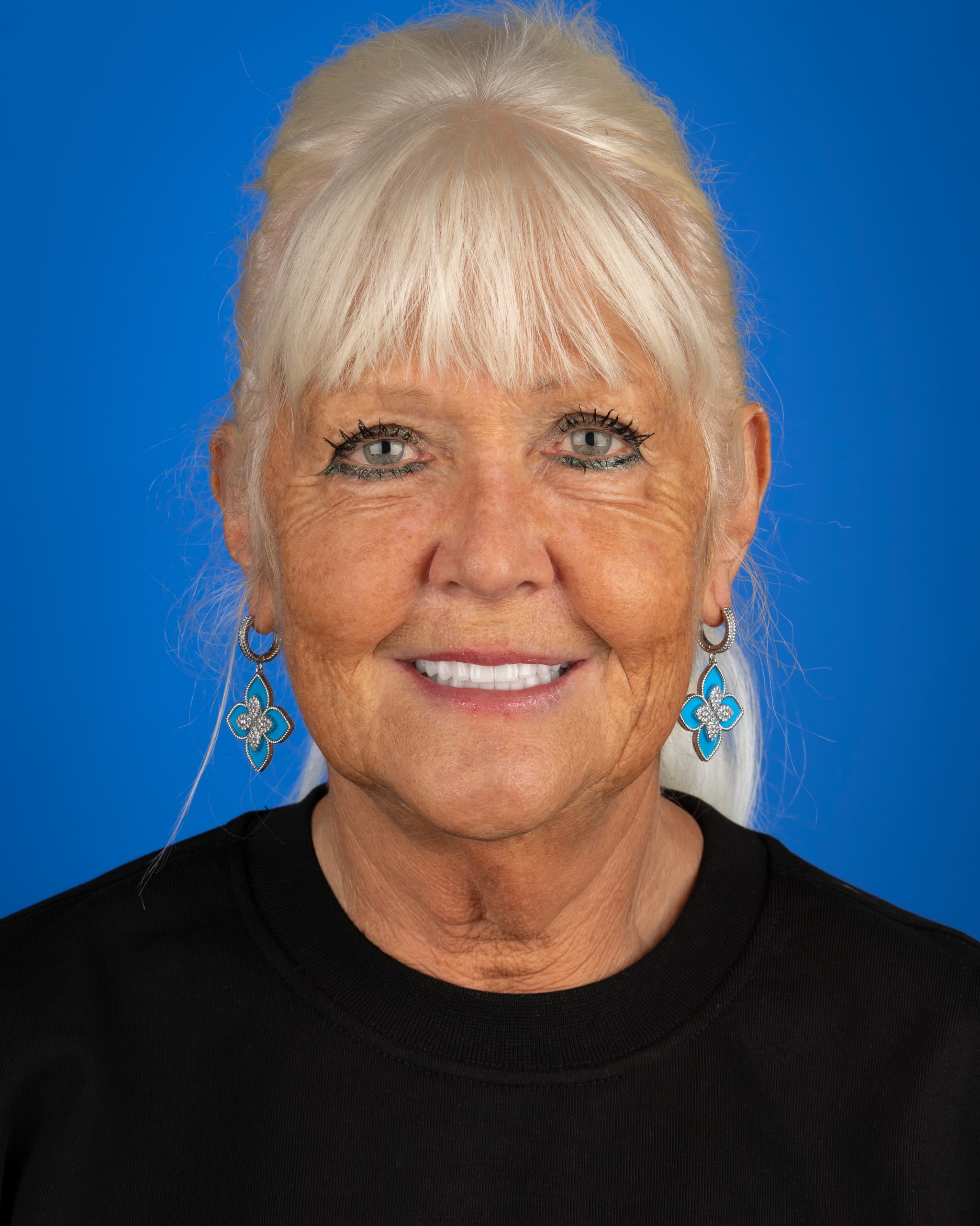 UK - Smile Design, 24x Zirconia Crowns